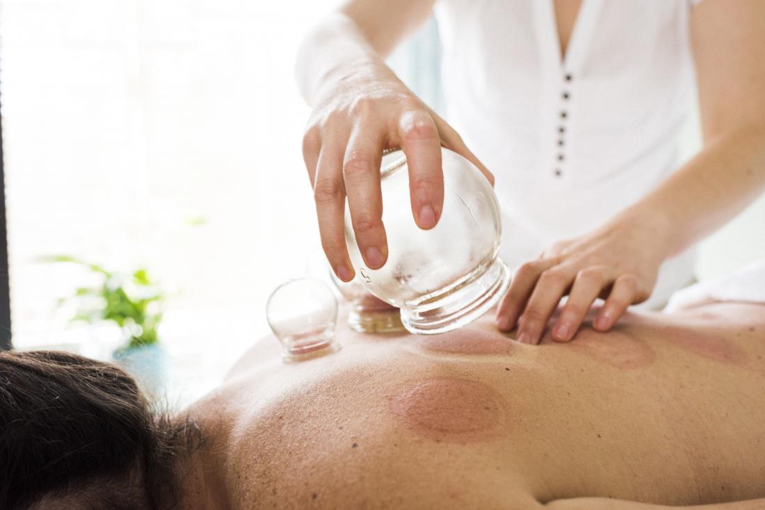 person having cupping therapy applied to back